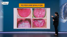 [약손+] 내 몸이 보내는 건강 신호 ‘혀 질환’ ④혀의 정상 변이-치흔·설균열