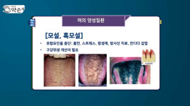 [약손+] 내 몸이 보내는 건강 신호 ‘혀 질환’ ⑥혀의 양성 질환-모설·설유두 비대