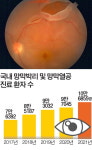 눈앞 벌레가 둥둥, 빛이 번쩍…실명 부르는 망막박리 신호