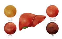 FDA, 최초의 지방간 치료제 ‘레즈디프라’ 승인