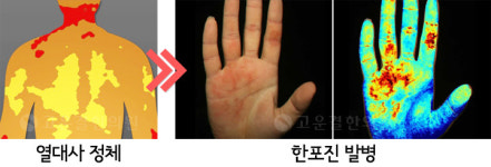 한포진 피부진료-콩닥콩닥 고운결한의원 일산점