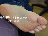한포진 전/후사진1-콩닥콩닥 고운결한의원 일산점