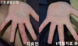 [한포진] 여름형한포진2-콩닥콩닥 고운결한의원 일산점