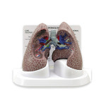 미국 폐모형 정상과 흡연자의폐 실제크기 G311 : 위너메디칼