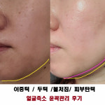 김포피부관리실 물방울리프팅 DPL 얼굴축소 스킨케어 김민희스파유르 : 김포피부관리 김민희스파유르