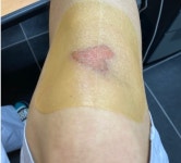 잘라쓰는 듀오덤 상처 재생 밴드 5매입 약국 치료 연고 얼굴 여드름 패치 흉터 복구 : 아람송이