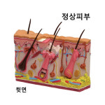 [GPI] 정상피부 와 여드름피부 비교모형 G3751 : 케이엠글로벌