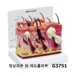 [GPI] 정상피부 와 여드름피부 비교모형 G3751 : 케이엠글로벌