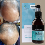 바로티나 뉴헤어토닉 탈모 영양제 엠자 정수리 두피 탈모에 좋은 영양제 100ml : 바로티나
