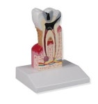 충치모형 : 조앤지컴퍼니