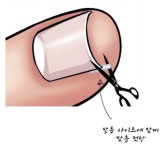 1+1 파고 들어가는 발톱 집에서 간단하게 리케어 보호 스틱 5개+5개 : 꿀템 매장