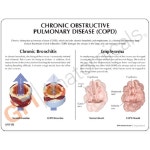 -미국 GPI 인체모형 만성폐쇄성폐질환모형 COPD G313 : 종로씨엔피