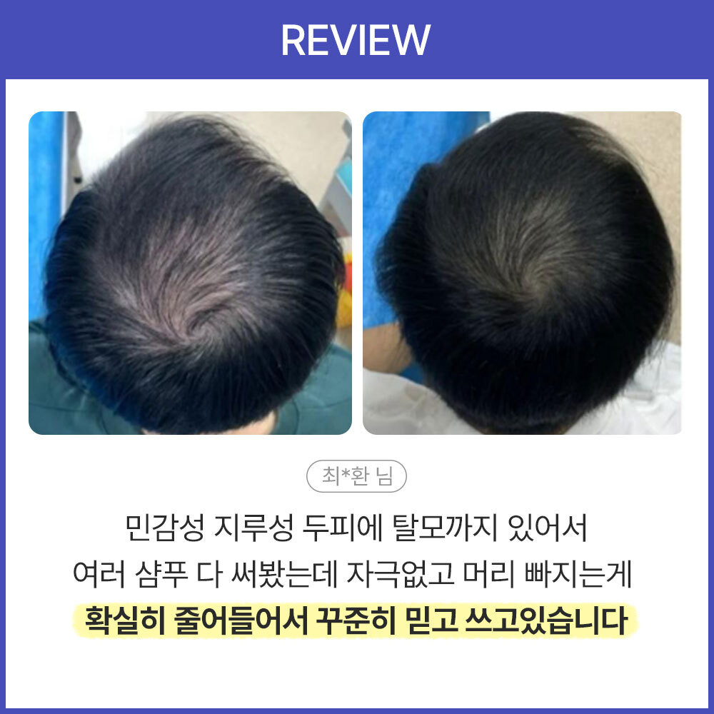 TS샴푸와 로스 샴푸, 헤머셀 스칼프 앤 헤어 토닉 플러스: 탈모 예방과 모발 관리에 관한 다양한 팁들[Interview]