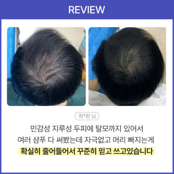 TS샴푸와 로스 샴푸, 헤머셀 스칼프 앤 헤어 토닉 플러스: 탈모 예방과 모발 관리에 관한 다양한 팁들[Interview]