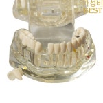 치과 교육 모델 연구 이동식 수지 재료 임플란트 복원 : 스팀팩마린