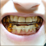 [출시 이벤트]바이오슬립밴드 입벌림방지 구강장치 양압기 필수 아이템  입테이프 대체 : 코골이 센터