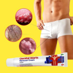 곤지름 연고 남자 생식기 사마귀 치료 콘딜로마 매독 헤르페스 제거 치료제 20g : 공감의 미