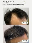 M자 이마 헤어라인 가발 패치