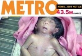 헉！인도에서 또 팔·다리 8개 아기 출생…‘신의 재림?’