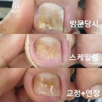 LCN네일니케_발톱교정,문제성손/발관리,조갑박리