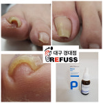 레푸스 경대점