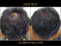 탈모 아미치 0.3 공덕점