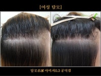 탈모 아미치 0.3 공덕점