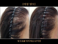 탈모 아미치 0.3 공덕점
