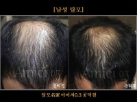탈모 아미치 0.3 공덕점