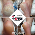 레푸스 구미시청점 내성발톱 발톱무좀 발각질