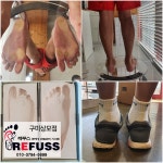 레푸스 구미시청점 내성발톱 발톱무좀 발각질