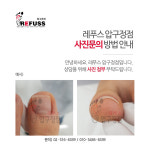 봉숭아손톱 레푸스 압구정점