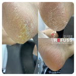 봉숭아손톱 레푸스 압구정점