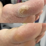 봉숭아손톱 레푸스 압구정점