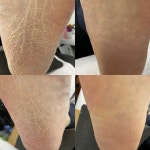 봉숭아손톱 레푸스 압구정점