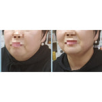 이아소에스떼
