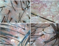 씨에스엘엠지에프두피탈모센타성성 | 마이모셀 두피센터 CST Healing