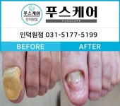 푸스양주 | 페디솔루션&푸스케어 양재점