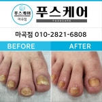 푸스케어 마곡점 내성발톱 무좀발톱 발각질 문제성발관리