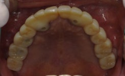 서울탑플란트치과의원