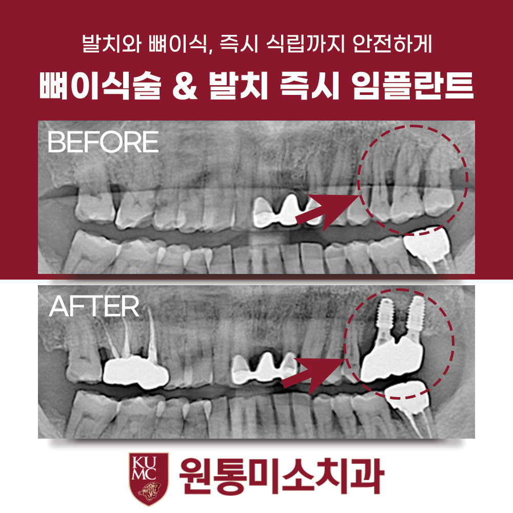 원통미소치과의원 광고