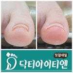 잇걸페디_내성무좀각질