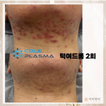 콜드플라즈마지사 아미뷰티 아카데미