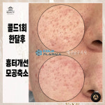콜드플라즈마지사 아미뷰티 아카데미