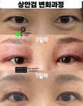 콜드플라즈마지사 아미뷰티 아카데미