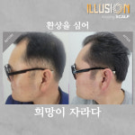 일루젼스칼프 안양