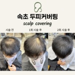 속초두피커버링