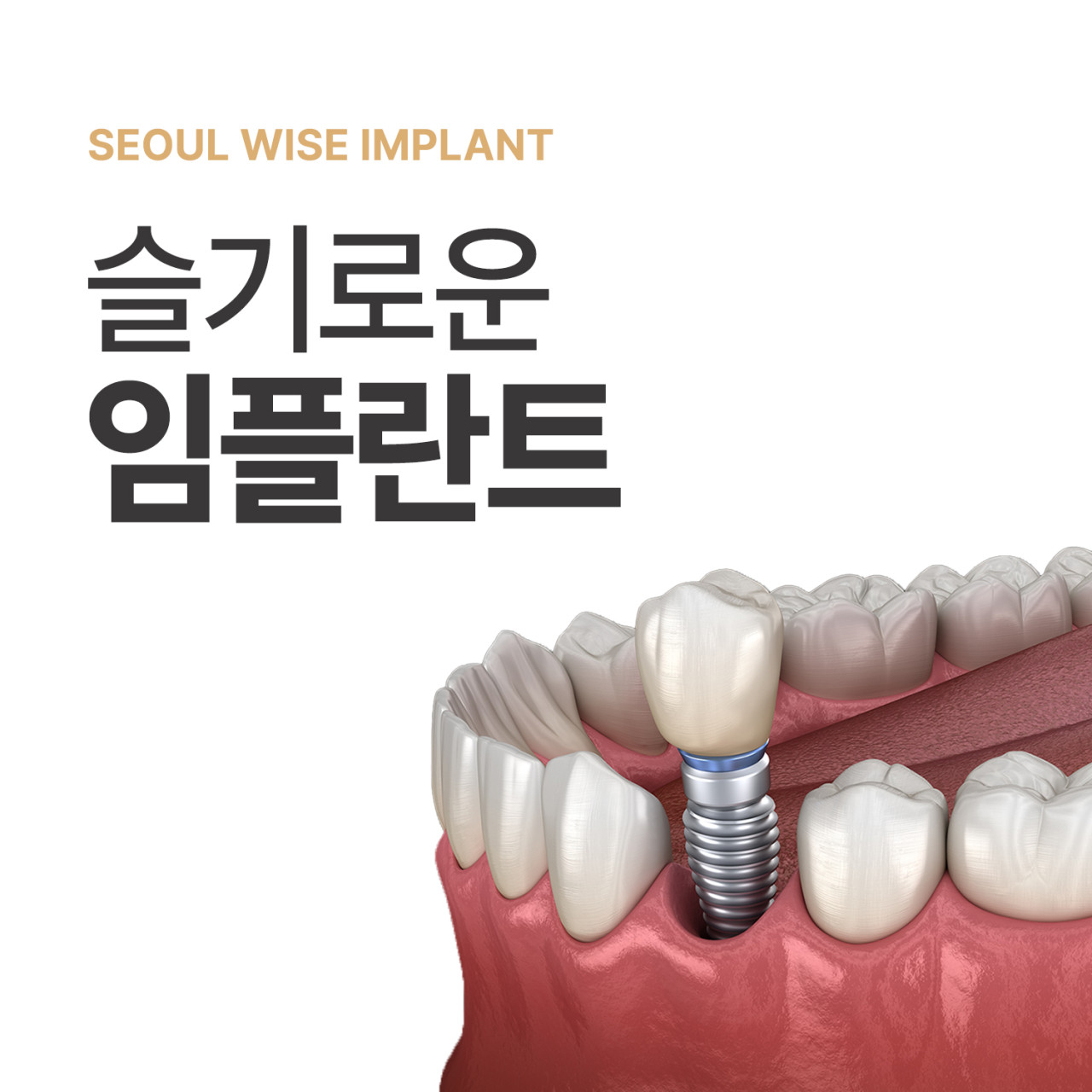 영등포구 당산동 임플란트 치과 추천