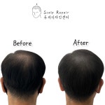 스칼프리페어 두피디자인센터