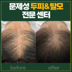 렛미인x모리바이브탈모&두피케어 인천부평점